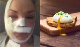 FOTO // O femeie s-a ales cu arsuri grave după ce a băgat un ou în cuptorul cu microunde